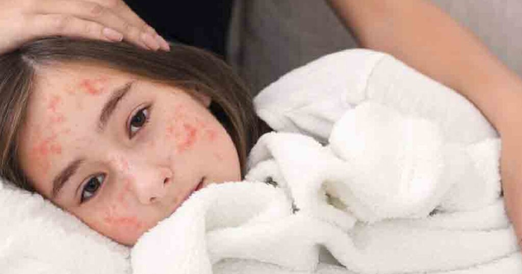 হাম হলে কী করবেন?